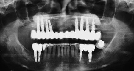 Bezzębna szczęka - na stałe zacementowany most na implantach - zdjęcie rentgenowskie mostu z koronami