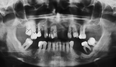 Bezzębna szczęka - na stałe zacementowany most na implantach - zdjęcie rentgenowskie