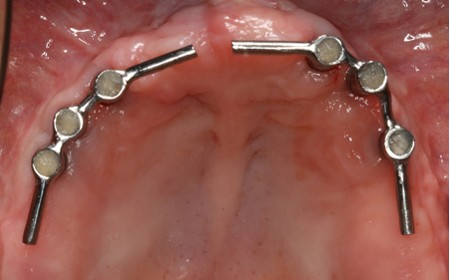 Bezzębna szczęka - wyjmowana ograniczona proteza na implantach - mosty na implantach w szczęce