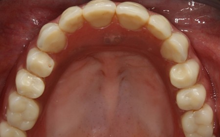 Bezzębna szczęka - wyjmowana ograniczona proteza na implantach - proteza założona na implantach