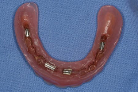 Bezzębna szczęka - wyjmowana ograniczona proteza na implantach - proteza