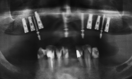 Bezzębna szczęka - wyjmowana ograniczona proteza na implantach - zdjęcie rentgenowskie implantów