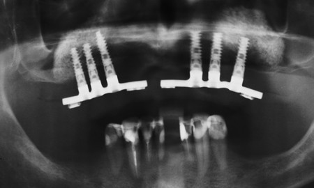 Bezzębna szczęka - wyjmowana ograniczona proteza na implantach - zdjęcie rentgenowskie implanty z mostami