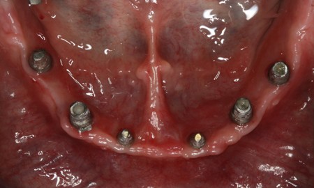 Bezzębna żuchwa - całkowity niewyjmowany most na implantach - implanty