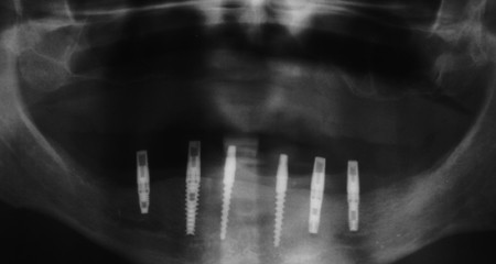 Bezzębna żuchwa - całkowity niewyjmowany most na implantach - zdjęcie rentgenowskie