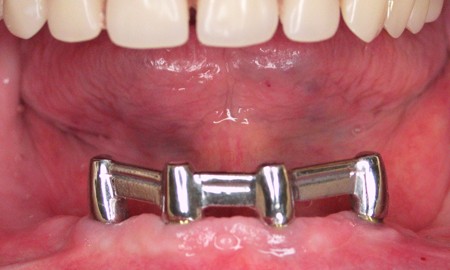 Bezzębna żuchwa - wyjmowana proteza na czterech implantach - Most 02