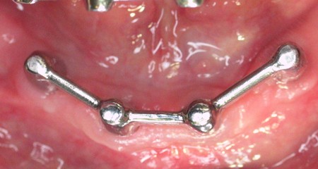 Bezzębna żuchwa - wyjmowana proteza na czterech implantach - most
