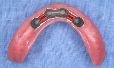 Bezzębna żuchwa - wyjmowana proteza na czterech implantach plastikowy model