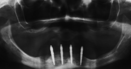 Bezzębna żuchwa - wyjmowana proteza na czterech implantach - zdjęcie rentgenowskie