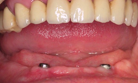 Bezzębna żuchwa - wyjmowana proteza na dwóch implantach - brak dolnej protezy