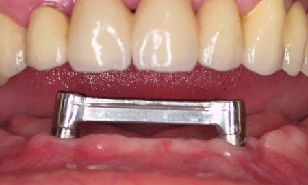 Bezzębna żuchwa - wyjmowana proteza na dwóch implantach - most na dwóch implantach