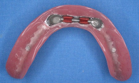 Bezzębna żuchwa - wyjmowana proteza na dwóch implantach plastikowy model