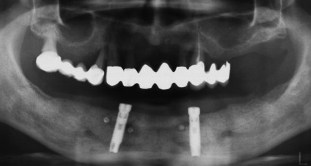 Bezzębna żuchwa - wyjmowana proteza na dwóch implantach - zdjęcie rentgenowskie