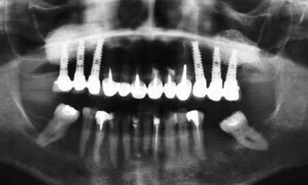Zdjęcie rentgenowskie z implantami zamiast bocznych zębów