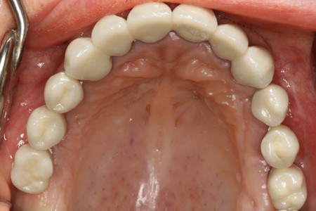 Brak bocznych zębów w szczęce zęby zastąpione implantami