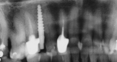 Natychmiastowe obciążanie implantów i uzupełnianie brakującego zęba - zdjęcie rentgenowskie implant