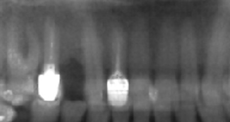 Natychmiastowe obciążanie implantów i uzupełnianie brakującego zęba - zdjęcie rentgenowskie zęba