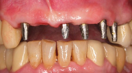 Rekonstrukcja brodawek międzyzębowych pomiędzy implantami - zamonotowane implanty