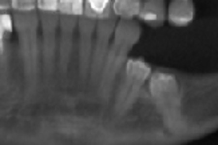 Usunięcie głęboko zatrzymanego zęba i natychmiastowa implantacja - Rentgen przed usunięciem