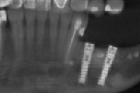 Usunięcie głęboko zatrzymanego zęba i natychmiastowa implantacja - Rentgen z implantami