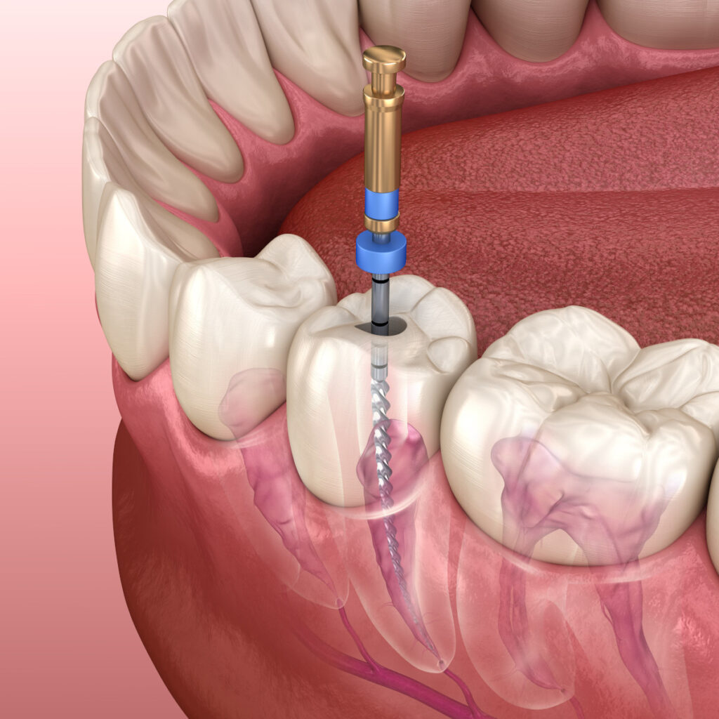 Leczenie endodontyczne jako przygotowanie do zabiegów stomatogicznych