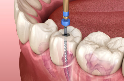 endodoncja jako przygotowanie do implantacji
