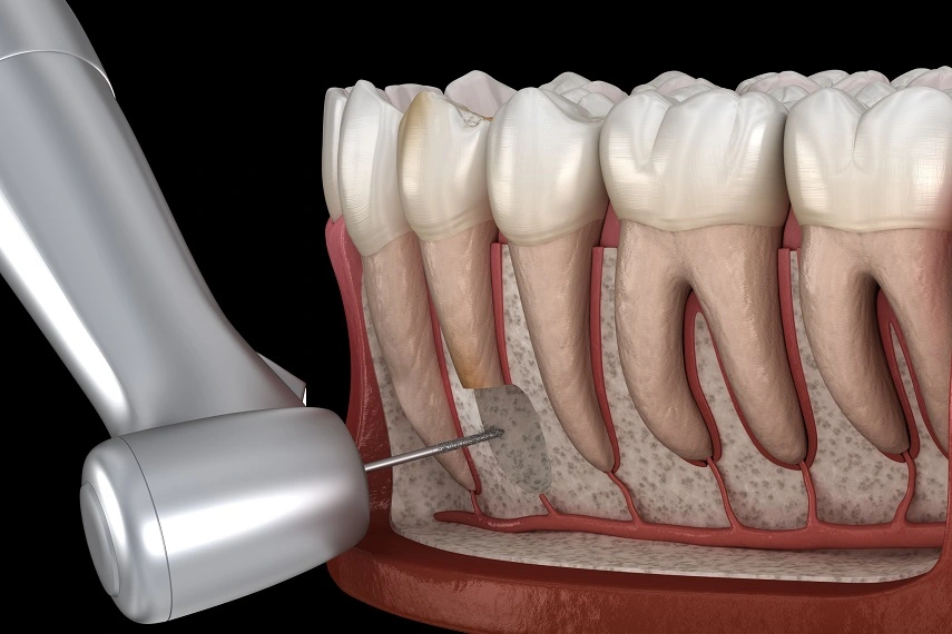 Endodoncja Szczecin - leczenie kanałowe