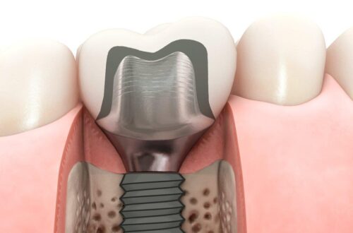 Implantacja natychmiastowa - kiedy warto się na nią zdecydować?
