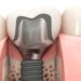 Implantacja natychmiastowa - kiedy warto się na nią zdecydować?