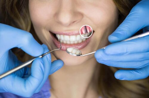 implantacja zębów w jednym vs. w dwóch etapach