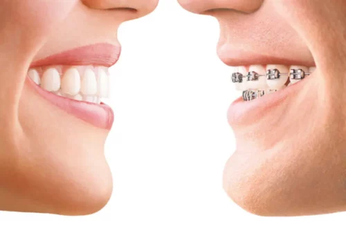 nakładki Invisalign - przełom w leczeniu ortodontycznym