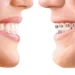 nakładki Invisalign - przełom w leczeniu ortodontycznym
