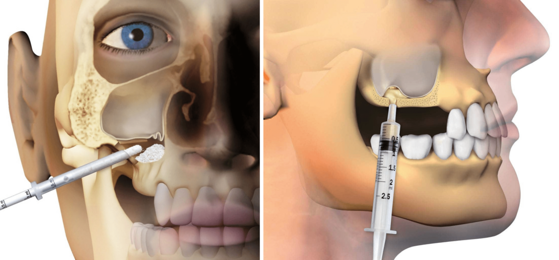 Zabieg podniesienia dna zatoki szczękowej przed procedurą implantacji