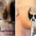 Zabieg podniesienia dna zatoki szczękowej przed procedurą implantacji
