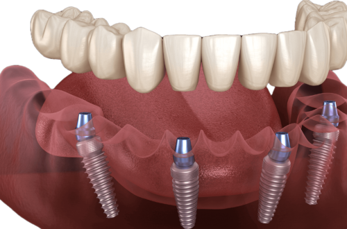All-on-4 - jedna z metod implantacji