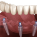All-on-4 - jedna z metod implantacji