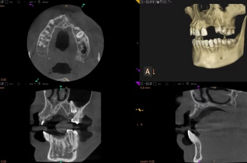 Augmentacja kości, odbudowa kości pod implantację