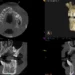 Augmentacja kości, odbudowa kości pod implantację