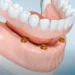 Protezy na implantach