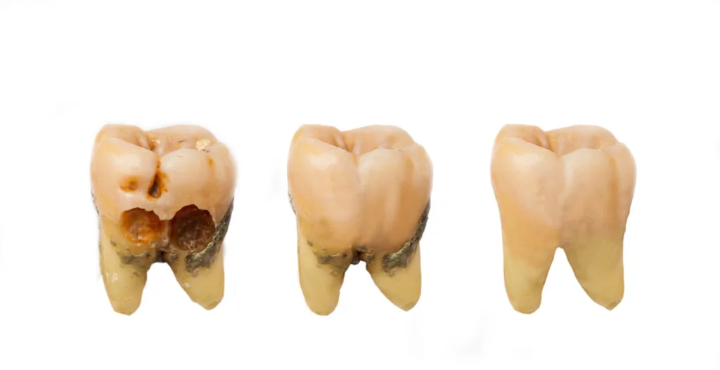 Próchnica Zębów Przyczyny Objawy Leczenie I Zapobieganie Sanadent 1599
