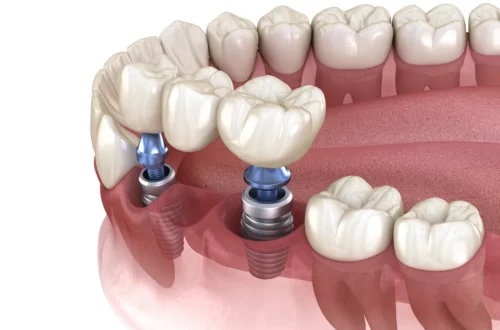 Zęby sąsiednie w procesie implantacji