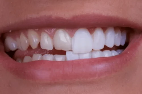 Licówki porcelanowe w Sanadent Stomatologia