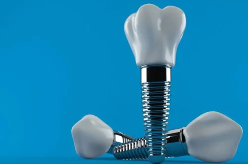 Implanty ceramiczne w stomatologia Sanadent Szczecin