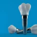 Implanty ceramiczne w stomatologia Sanadent Szczecin