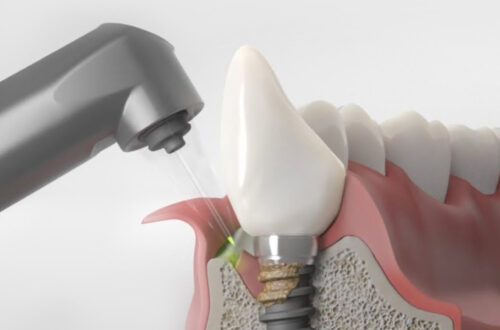 Periimplantitis – co to jest i jak temu zapobiec?
